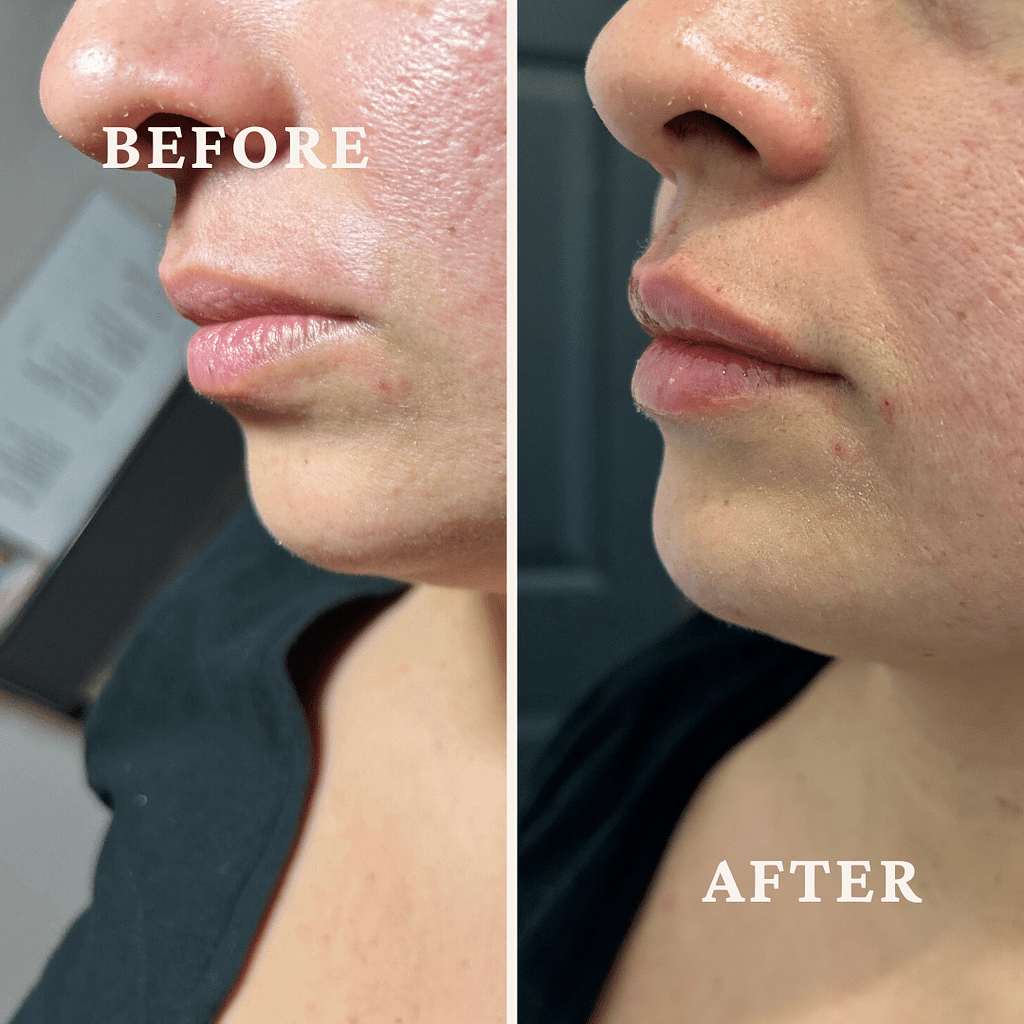 female lip and chin enhancement medpa dewey